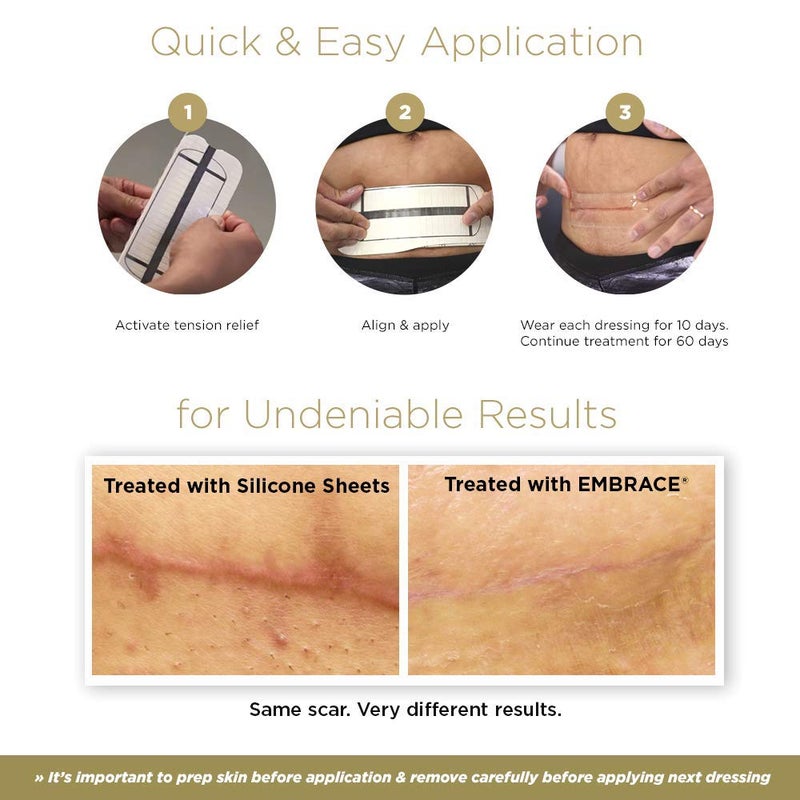 Embrace Active Scar Defense for New Scars, FDA-Cleared Medical-Grade Silicone Scar Sheets for Hypertrophic & Keloid Scar Treatment, 6.3 Inch, Extra-Large, 30-Day Supply - Image 4